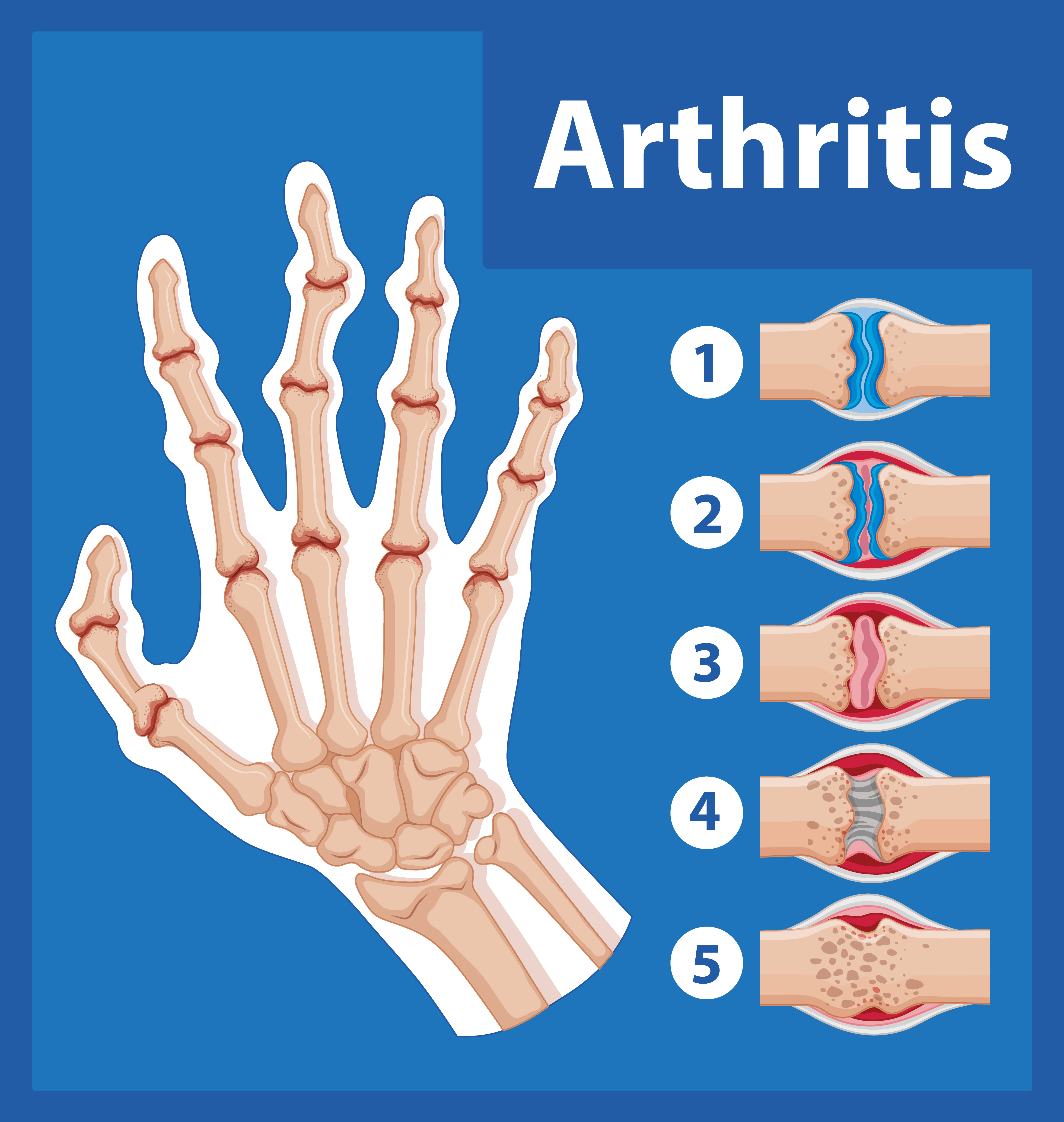 Arthritis Various Joints
